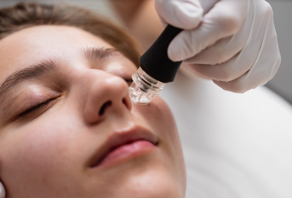 Microneedling Eyes (1)